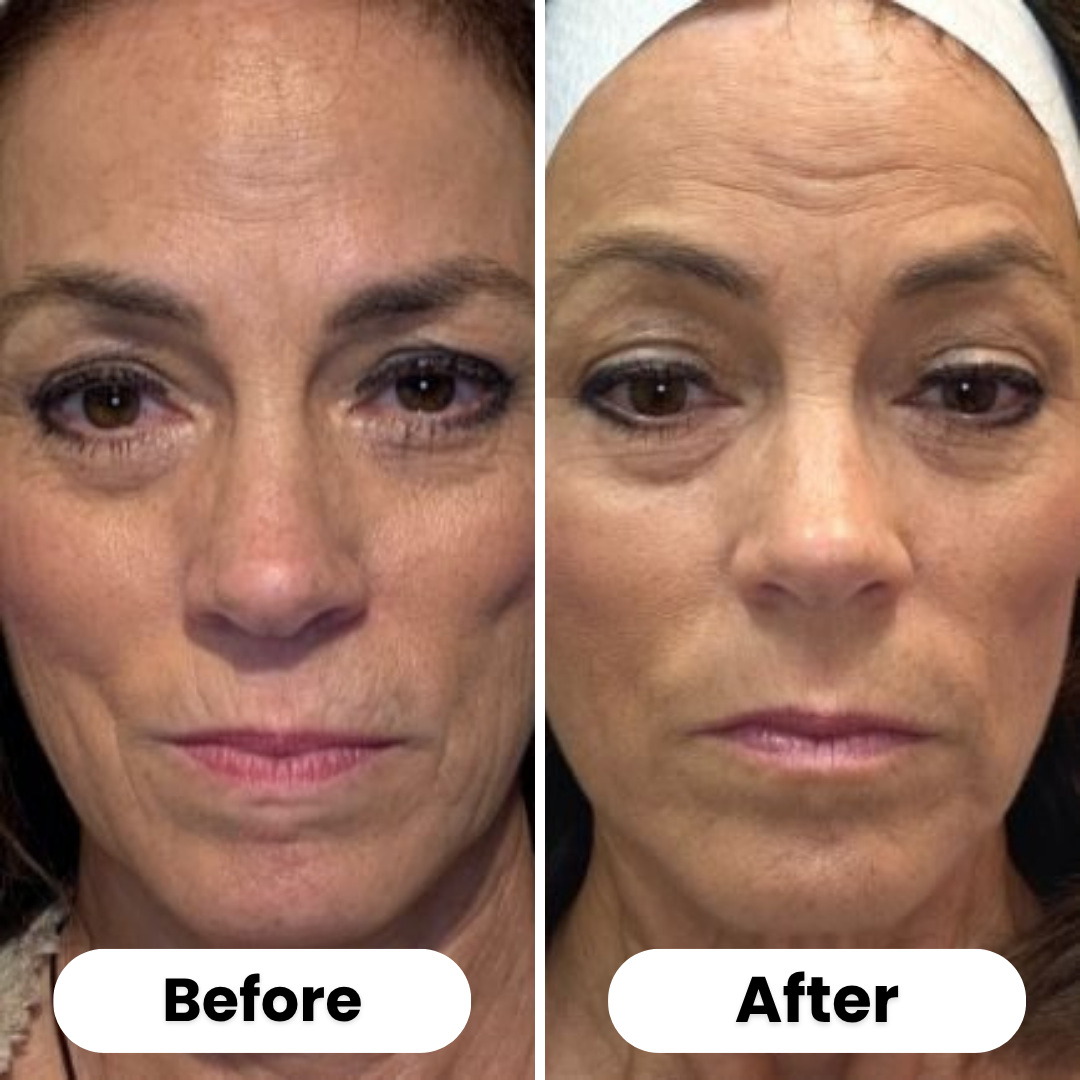 Dermy™ | Microneedling Stamp