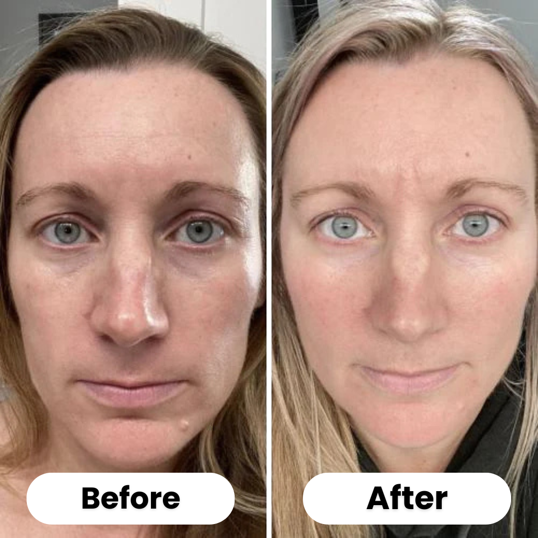 Dermy™ | Microneedling Stamp