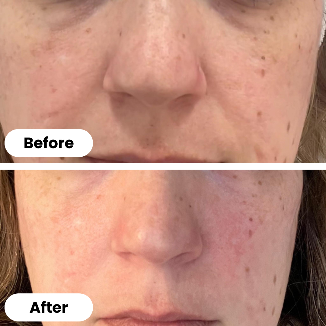 Dermy™ | Microneedling Stamp